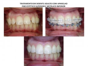 Aparelho transparente