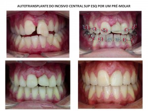 Autotransplante 21-34
