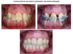 Extracção de 2 dentes